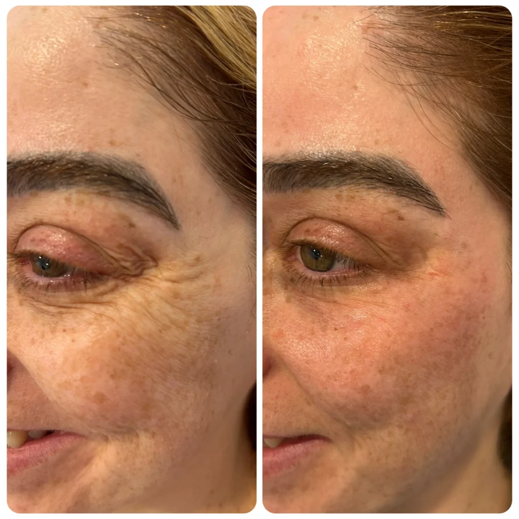 Jalupro before and after in Dubai by Dr. Azra Vaziri — skin quality and radiance improved