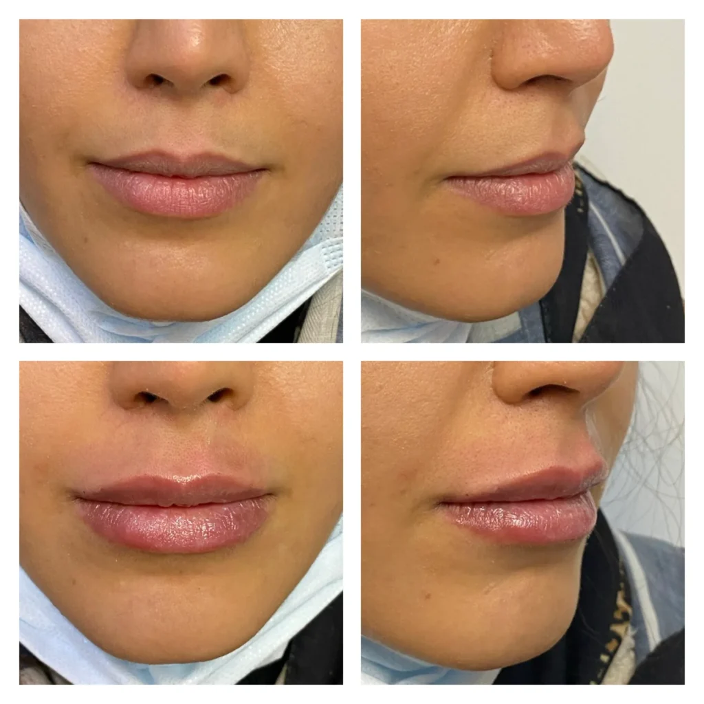 Lip filler before and after in Dubai by Dr. Azra Vaziri &mdash; natural volume and definition