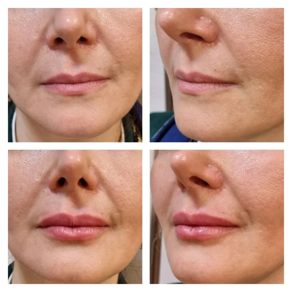 Lip filler before and after by Dr. Azra Vaziri in Dubai &mdash; shape refined in four views