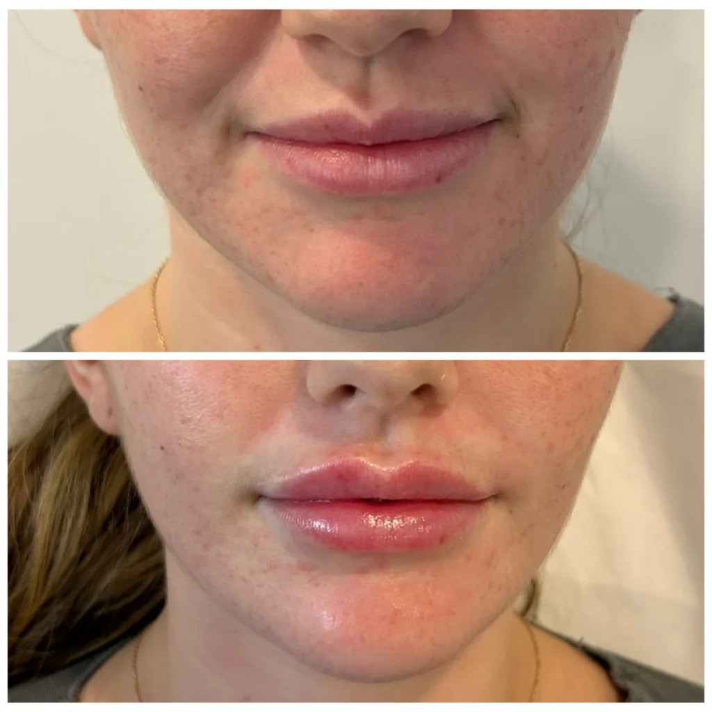Lip filler before and after in Dubai by Dr. Azra Vaziri &mdash; fuller, hydrated lips with natural shape
