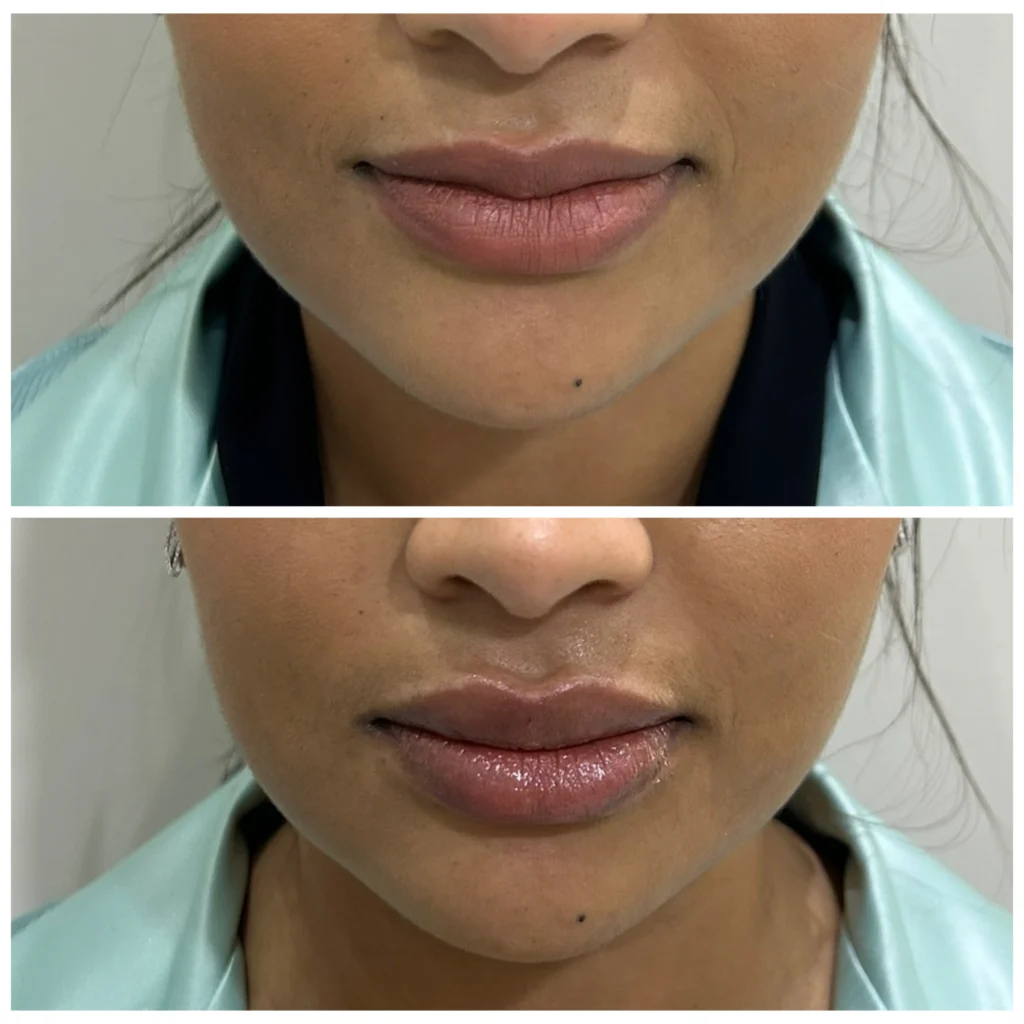 Lip filler before and after in Dubai by Dr. Azra Vaziri &mdash; natural volume and definition, front view