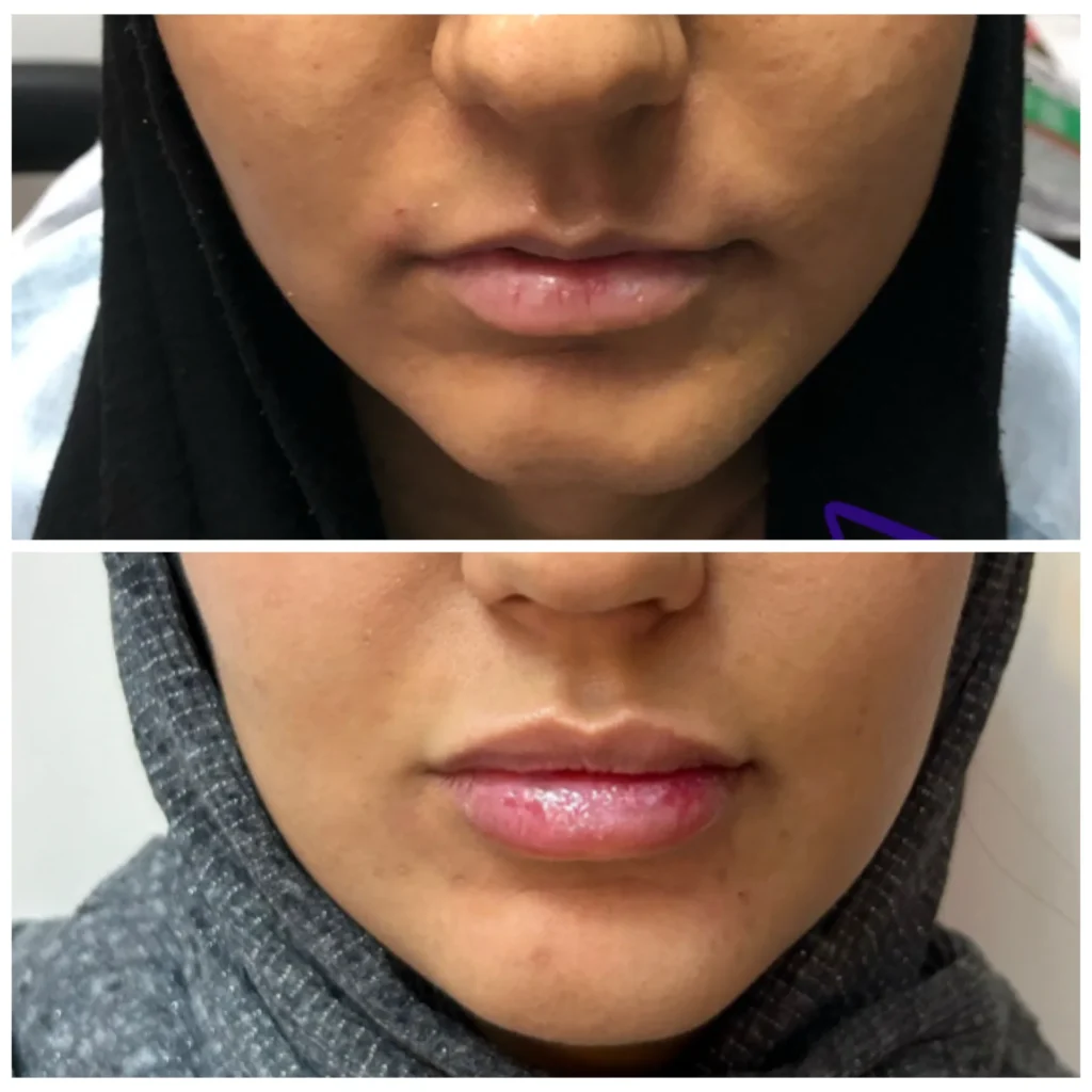 Lips and chin filler with skin booster before and after in Dubai by Dr. Azra Vaziri