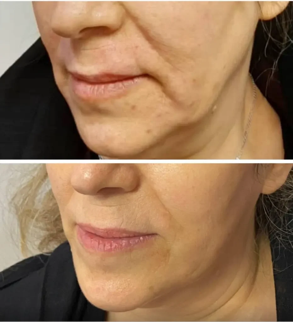 Skin tightening before and after in Dubai by Dr. Azra Vaziri — firmer jawline and reduced sagging of the lower face