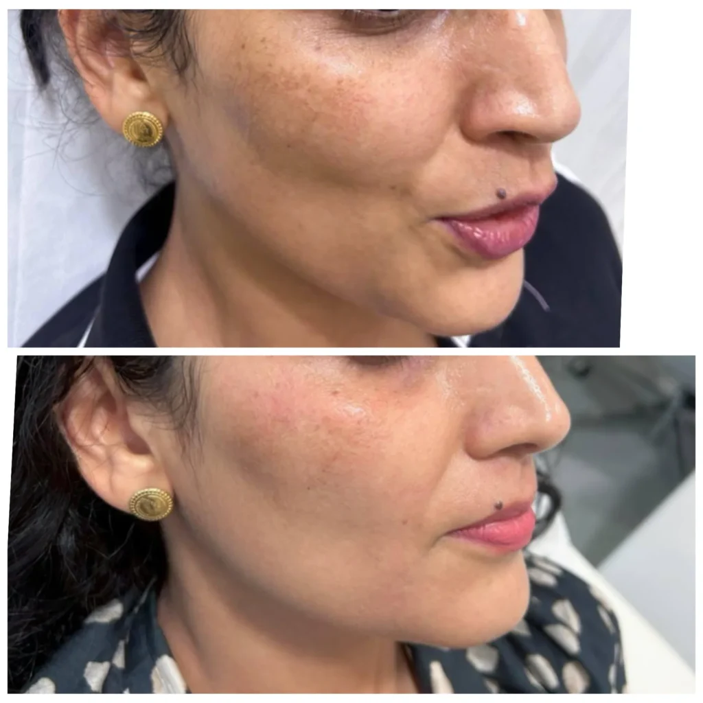 Melasma treatment before and after in Dubai by Dr. Azra Vaziri — patches visibly faded