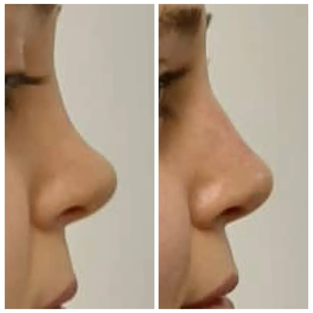 Non-surgical rhinoplasty with nose filler before and after in Dubai by Dr. Azra Vaziri, profile view