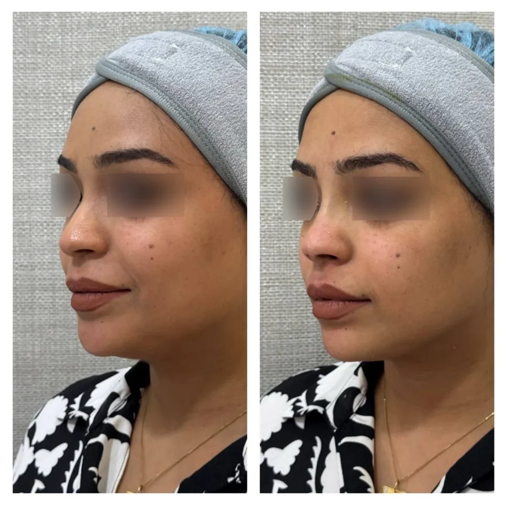 Nose thread lift before and after in Dubai by Dr. Azra Vaziri &mdash; bridge straighter and tip lifted