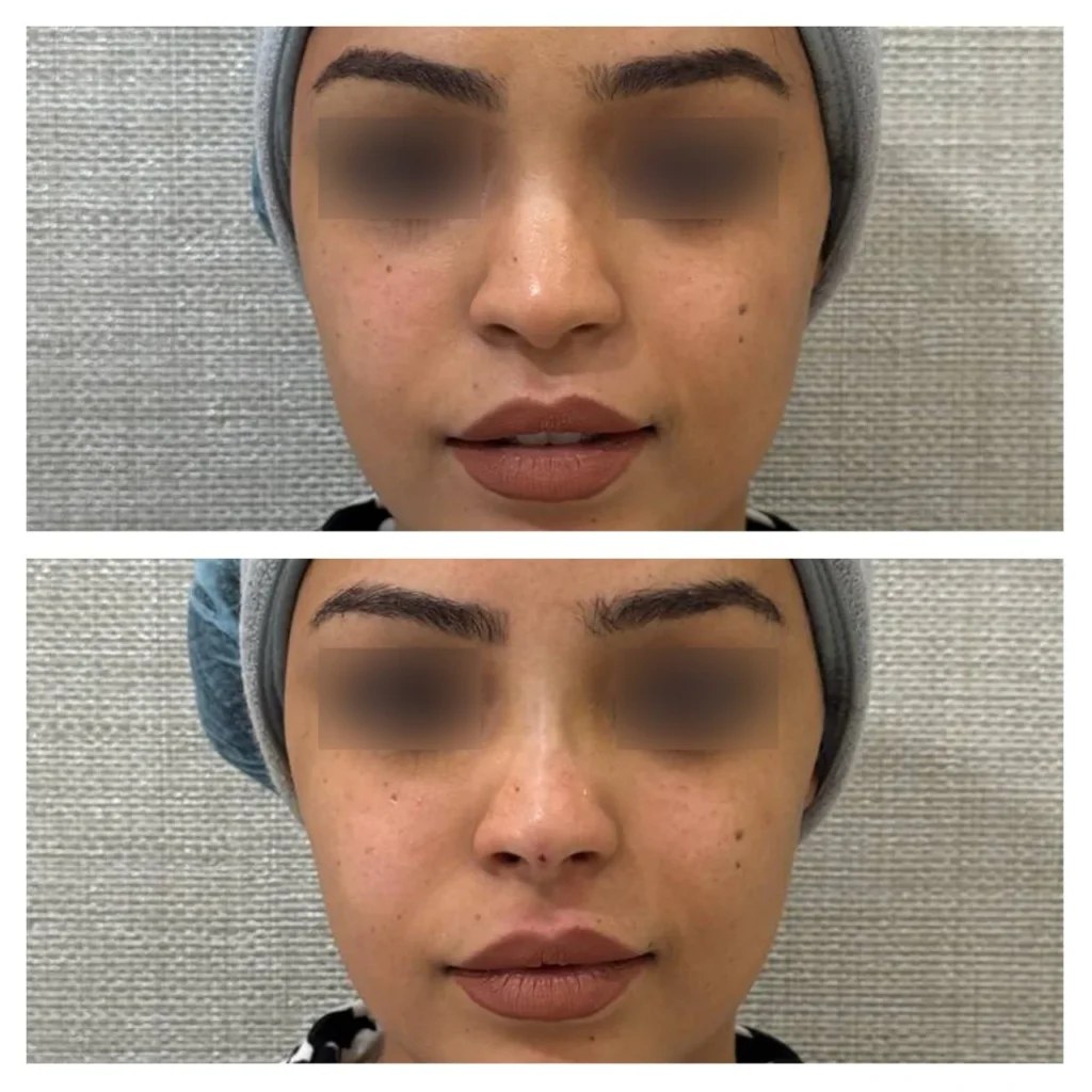 Nose thread lift before and after by Dr. Azra Vaziri in Dubai &mdash; refined nose shape, front view