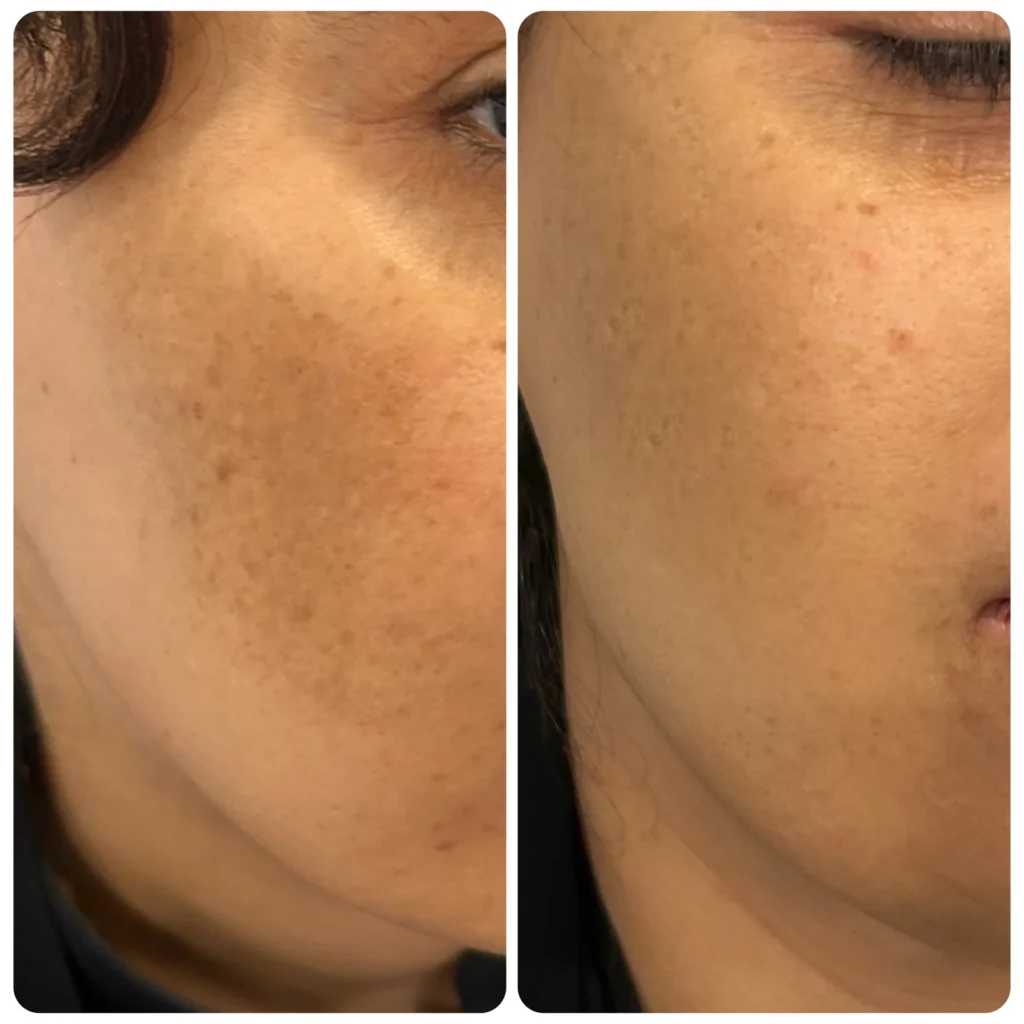 Pigmentation treatment before and after in Dubai by Dr. Azra Vaziri — dark spots visibly faded