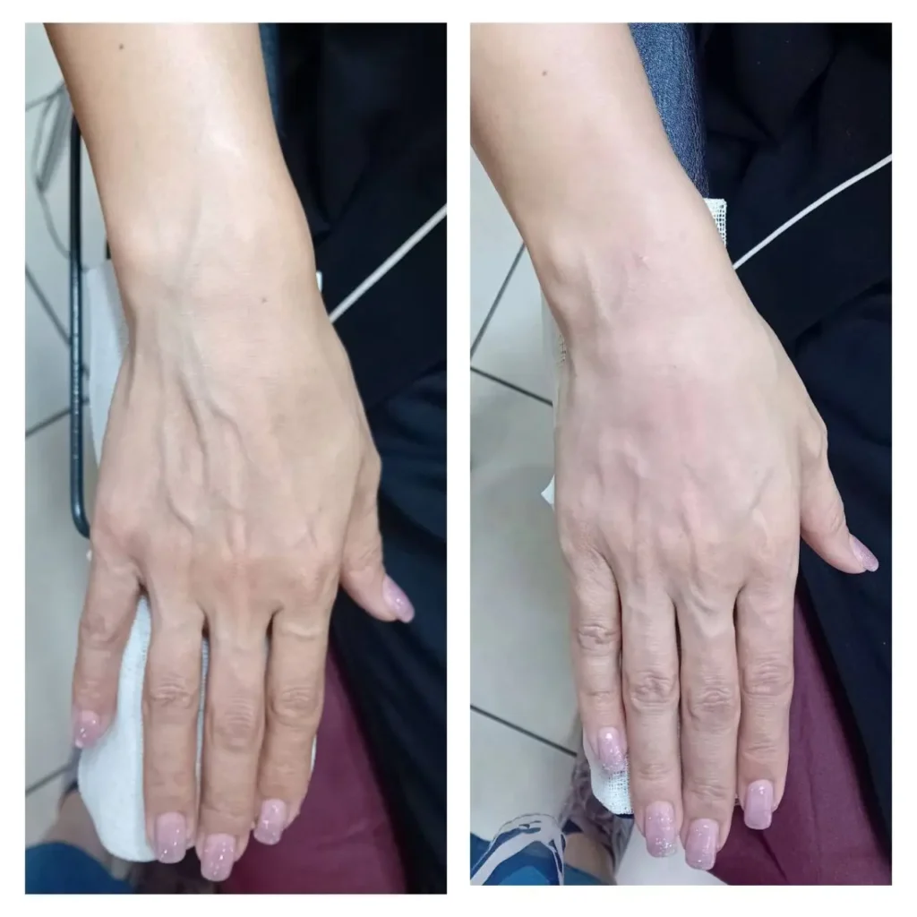 Hand rejuvenation before and after in Dubai by Dr. Azra Vaziri — Radiesse hand filler, veins and tendons less prominent