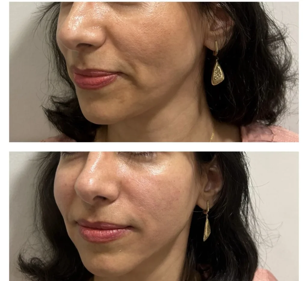 Radiesse before and after in Dubai by Dr. Azra Vaziri &mdash; firmer, fresher mid and lower face