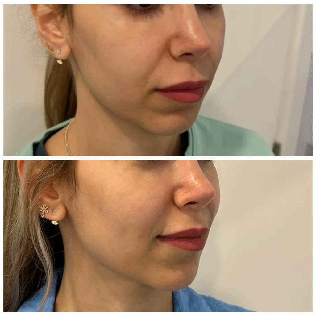 Radiesse before and after in Dubai by Dr. Azra Vaziri &mdash; jawline and lower face lifted