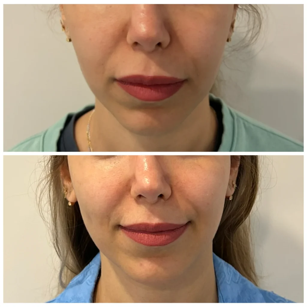 Radiesse before and after in Dubai by Dr. Azra Vaziri &mdash; jawline definition restored