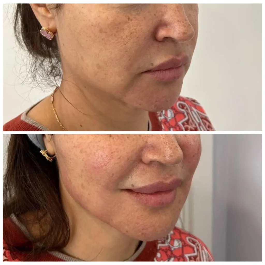 Radiesse before and after in Dubai by Dr. Azra Vaziri &mdash; lower face lifted and better supported