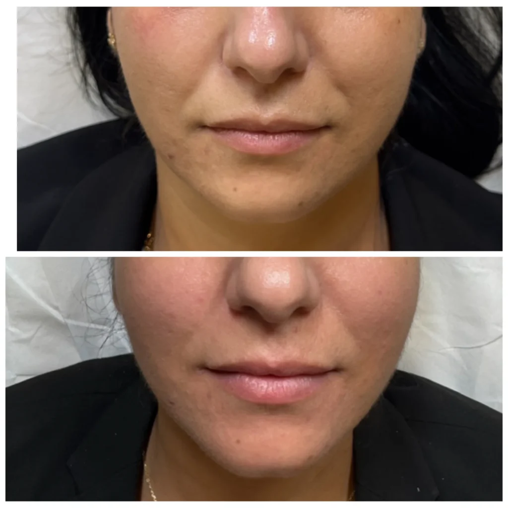 RF microneedling before and after in Dubai by Dr. Azra Vaziri &mdash; smoother, tighter skin texture