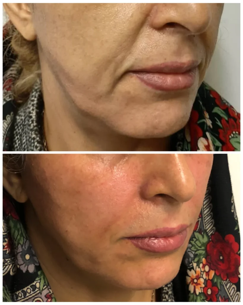 Sculptra before and after in Dubai by Dr. Azra Vaziri &mdash; gradual collagen renewal, natural firmness