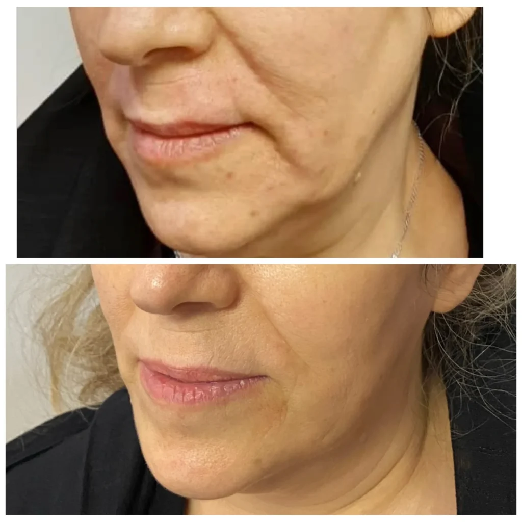 Sculptra plus skin booster before and after in Dubai by Dr. Azra Vaziri &mdash; firmer, better-quality skin