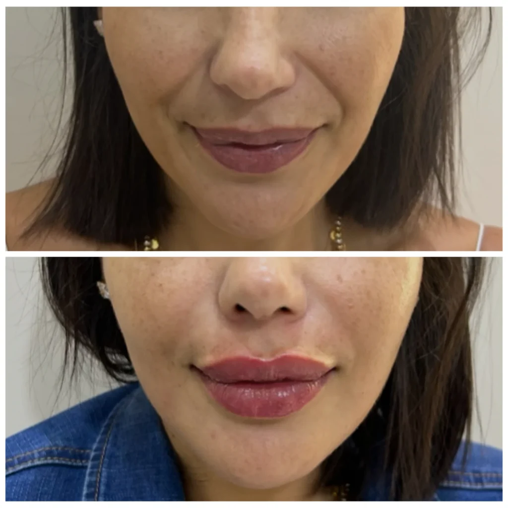 Smile line and lip filler before and after in Dubai by Dr. Azra Vaziri — nasolabial folds softened