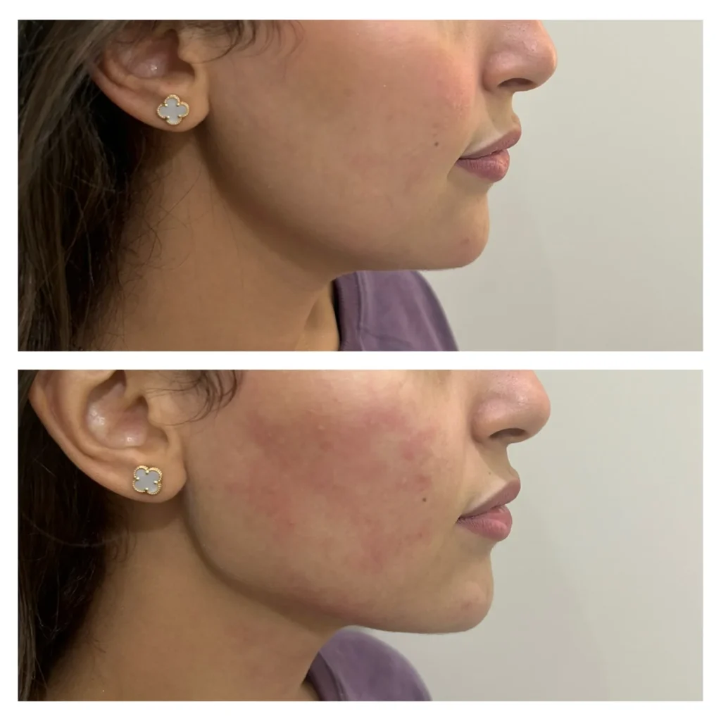 Texas jawline filler before and after in Dubai by Dr. Azra Vaziri — defined jaw angle