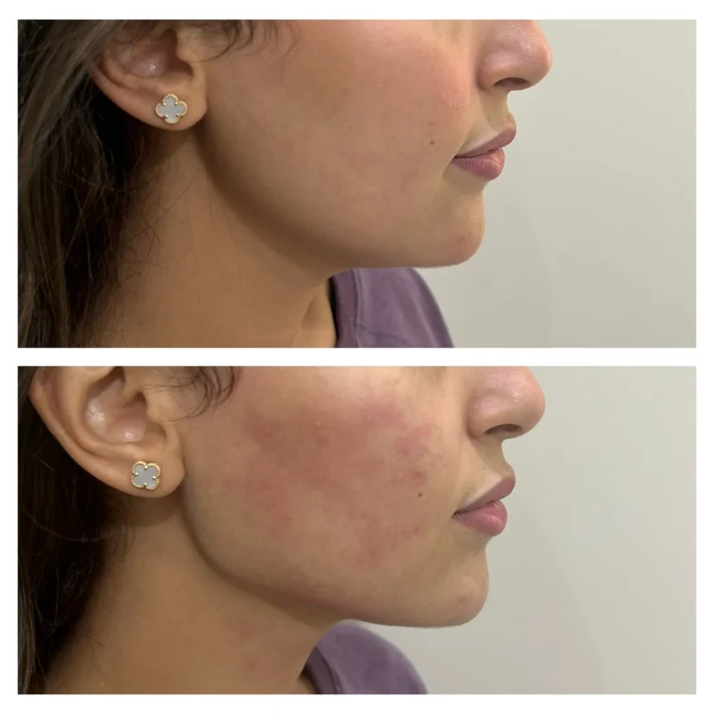 Texas jawline filler before and after in Dubai by Dr Azra Vaziri