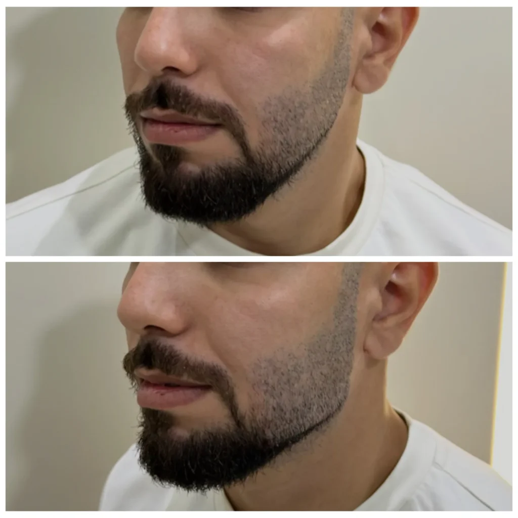 Texas jawline filler for men before and after in Dubai by Dr. Azra Vaziri — stronger jawline definition