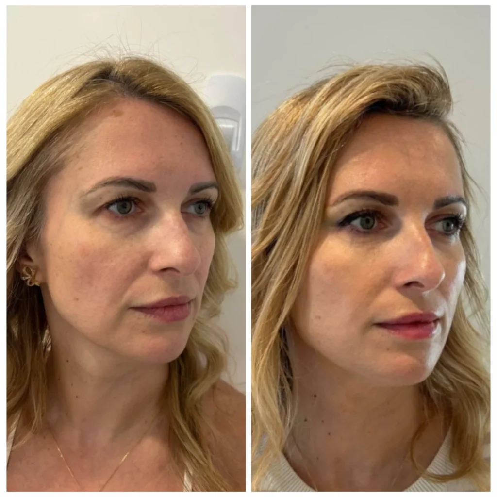 Face thread lift before and after in Dubai by Dr. Azra Vaziri &mdash; mid-face lifted