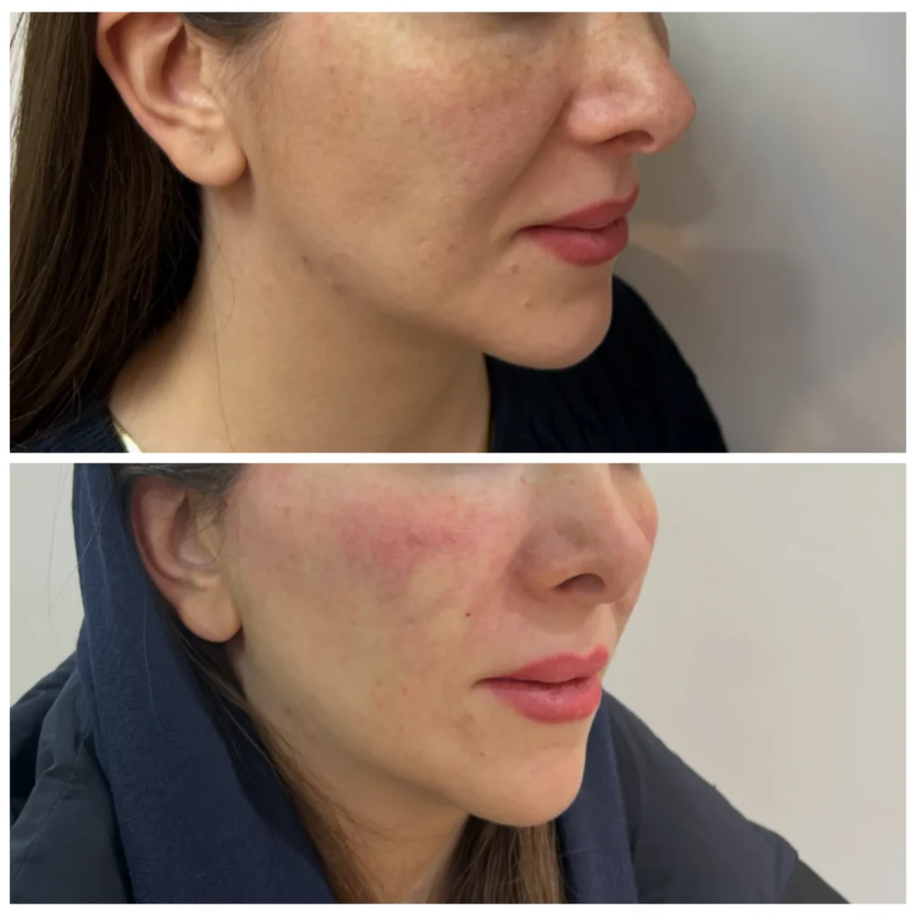 Thread lift before and after in Dubai by Dr. Azra Vaziri &mdash; mid-face and jawline repositioned