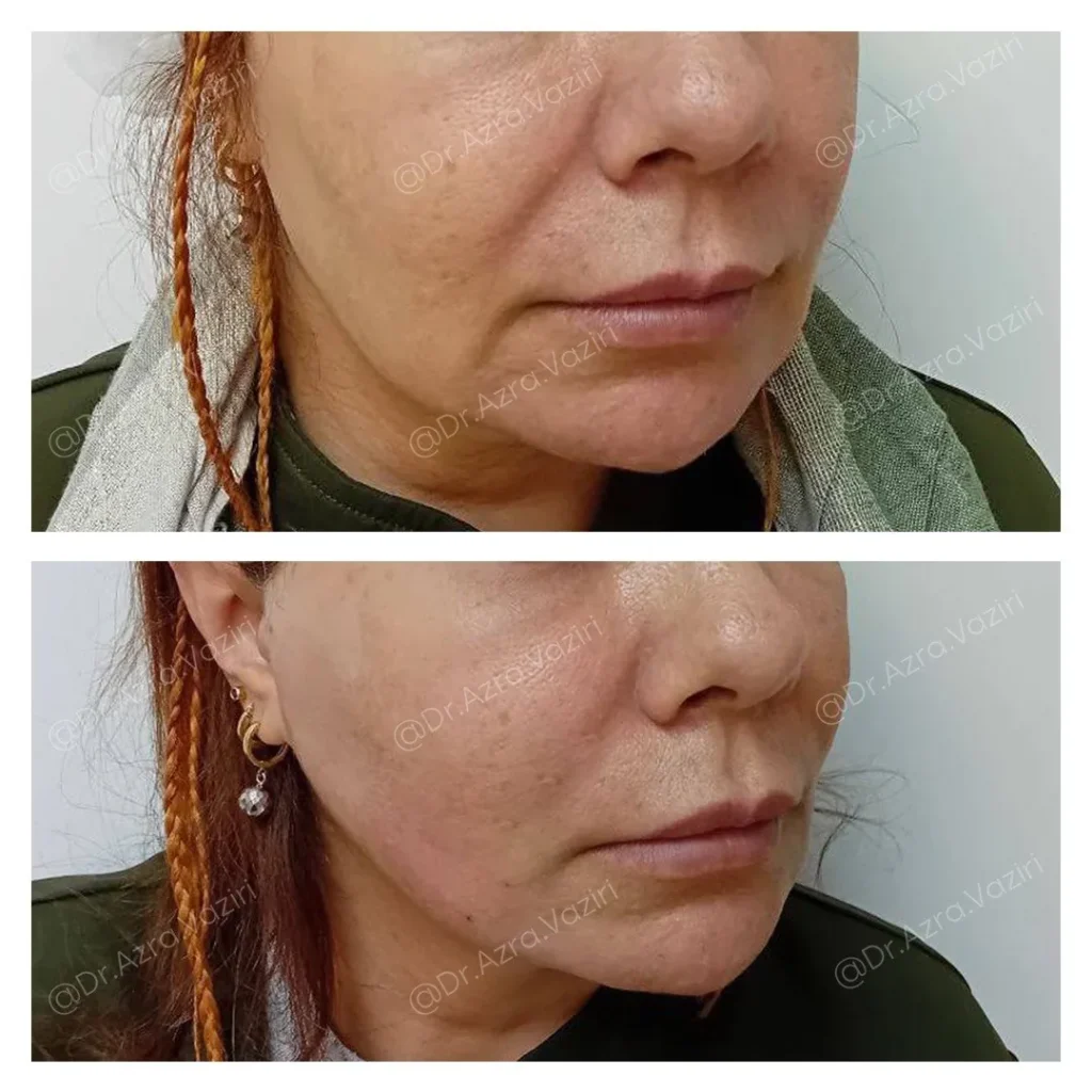 Thread lift for marionette lines before and after in Dubai by Dr. Azra Vaziri