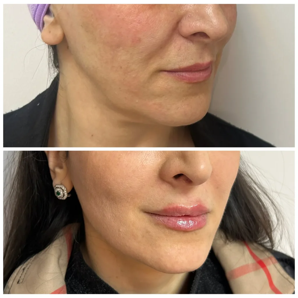 Thread lift combined with lip filler before and after in Dubai by Dr. Azra Vaziri