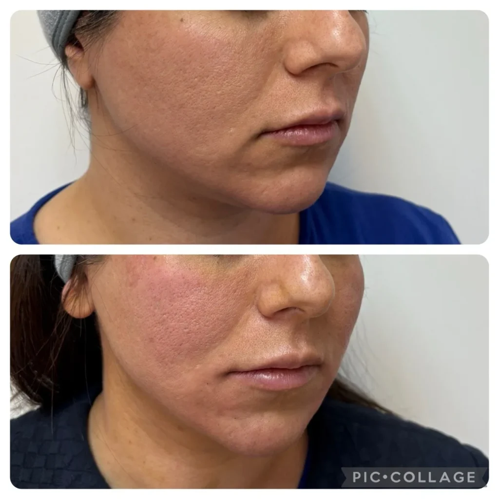 Marionette lines treated with Aptos threads before and after in Dubai by Dr. Azra Vaziri