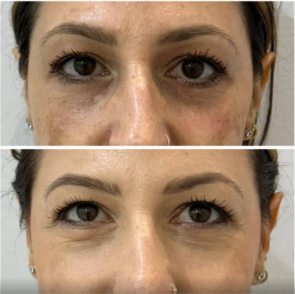 Under-eye filler before and after in Dubai by Dr. Azra Vaziri &mdash; tear trough hollowing softened