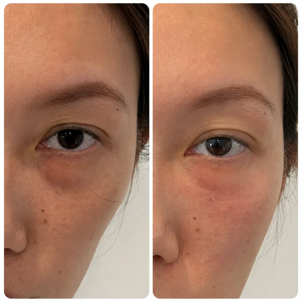 Under-eye filler before and after in Dubai by Dr. Azra Vaziri &mdash; tear trough hollowing softened