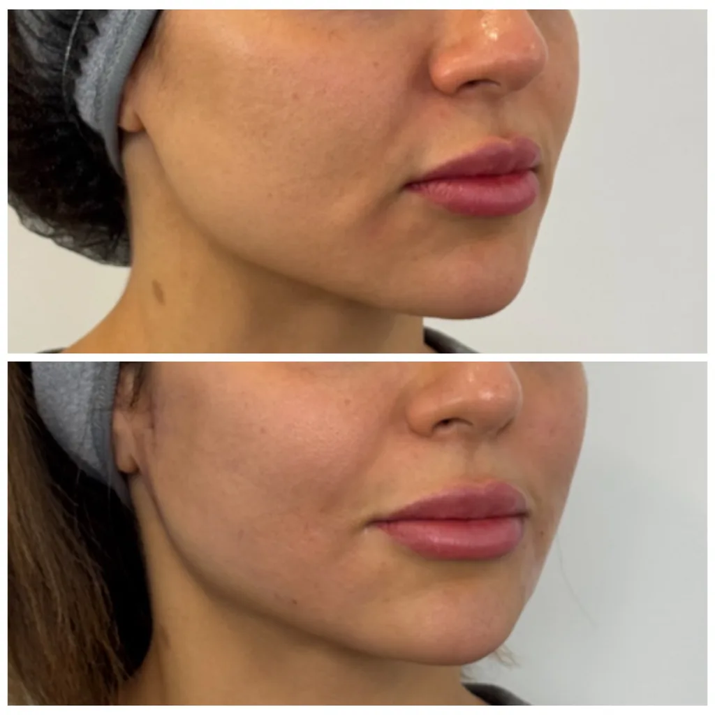 Aptos thread lift before and after in Dubai by Dr. Azra Vaziri — cheek lifted and the jowl line softened, before (top) and after (bottom)