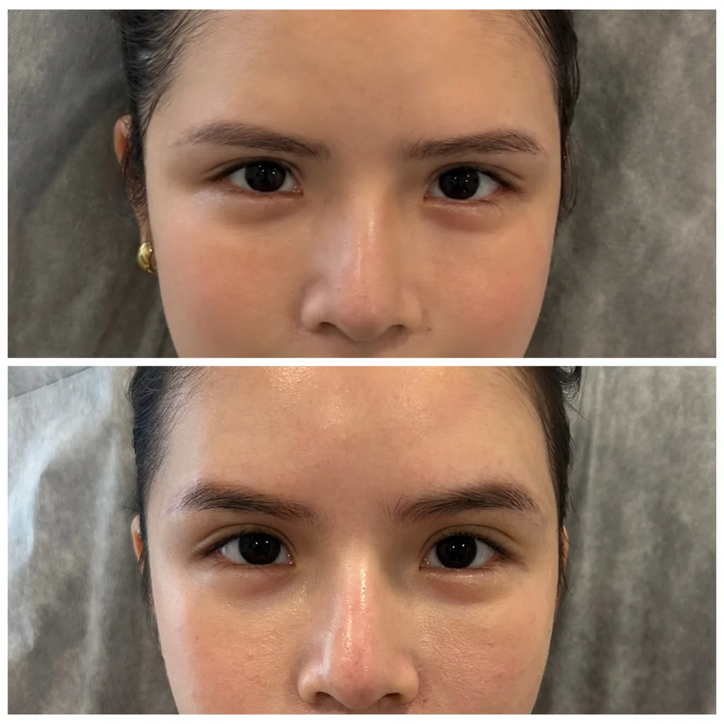 Botox brow lift before and after in Dubai by Dr. Azra Vaziri — brows gently raised and the eyes more open, before (top) and after (bottom)