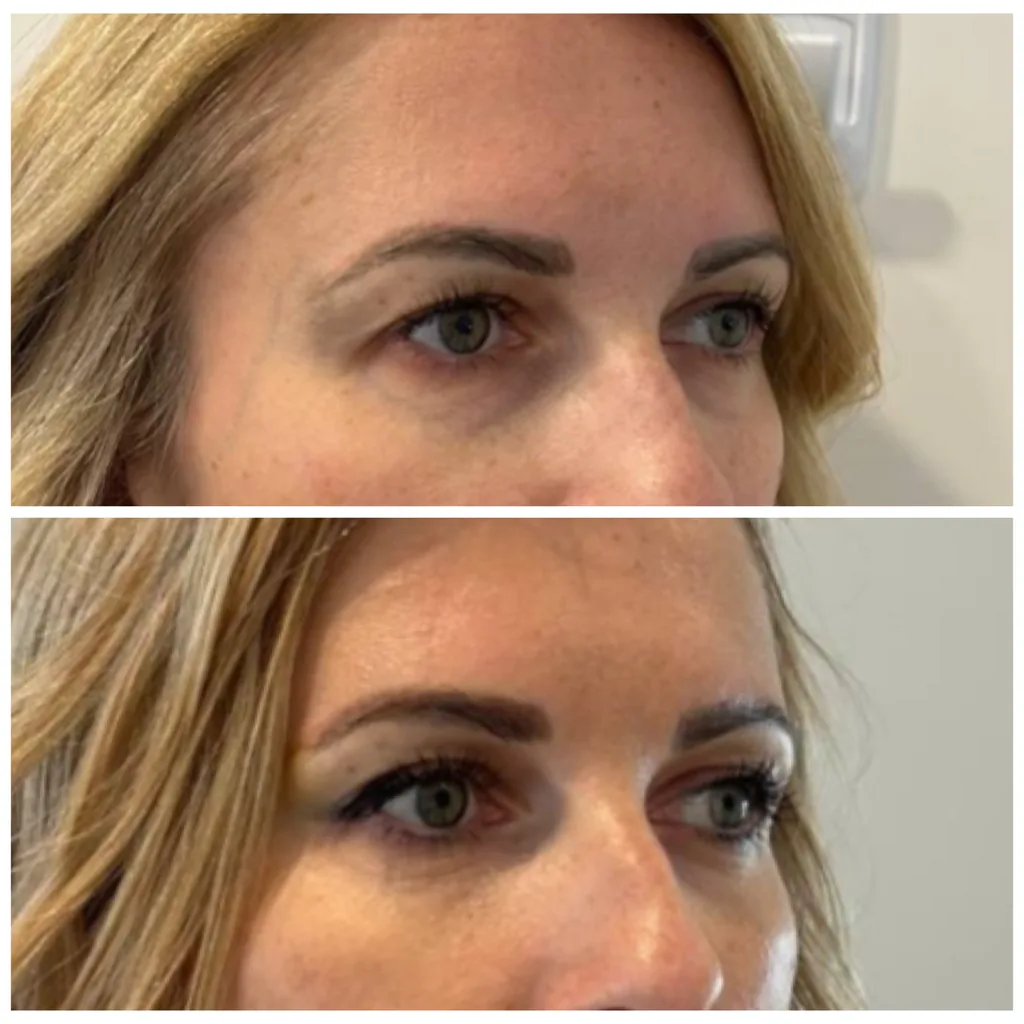 Botox brow lift before and after in Dubai by Dr. Azra Vaziri — a subtle lift of the brow line, before (top) and after (bottom)