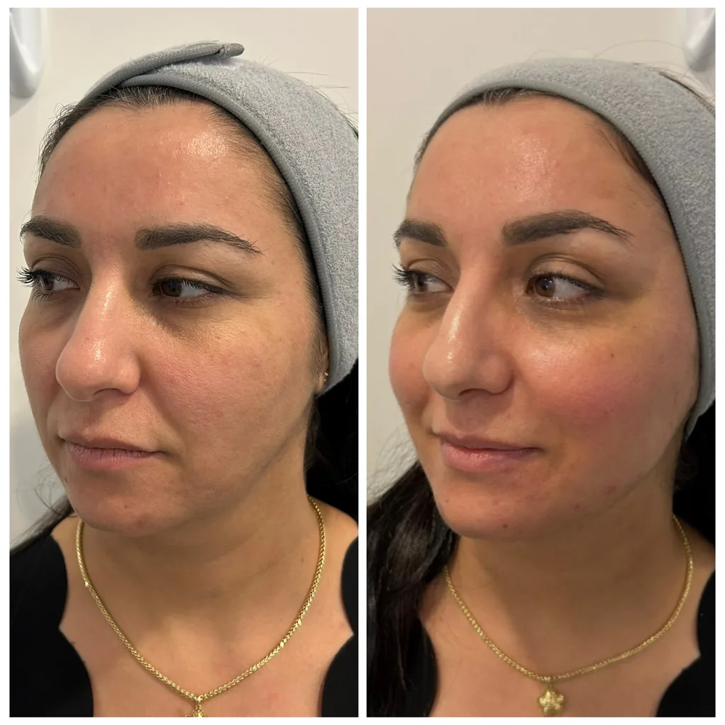 Calcium hydroxylapatite biostimulator before and after in Dubai by Dr. Azra Vaziri — firmer, better-supported lower face, before (left) and after (right)