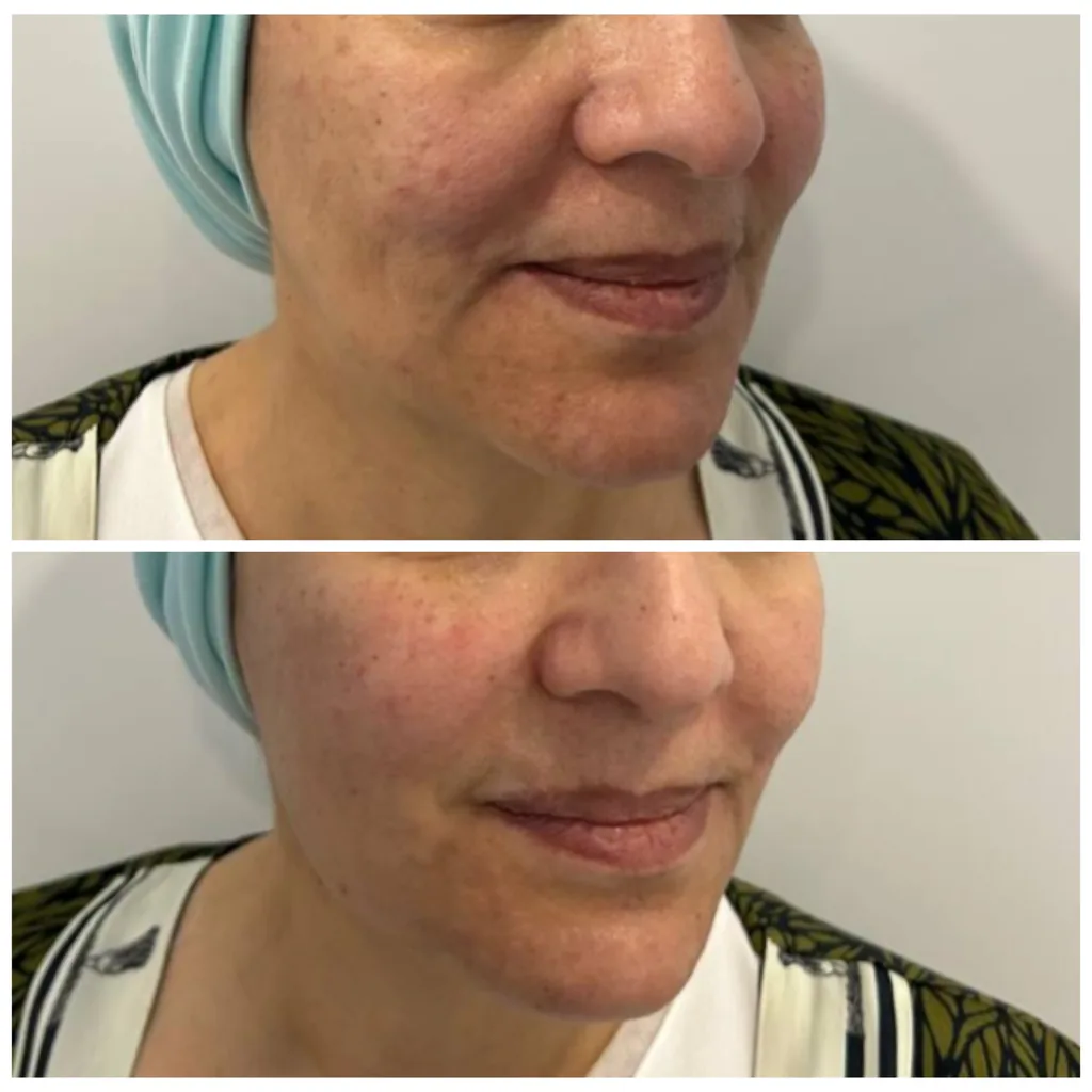 Cheek filler before and after in Dubai by Dr. Azra Vaziri — mid-face volume restored, before (top) and after (bottom)