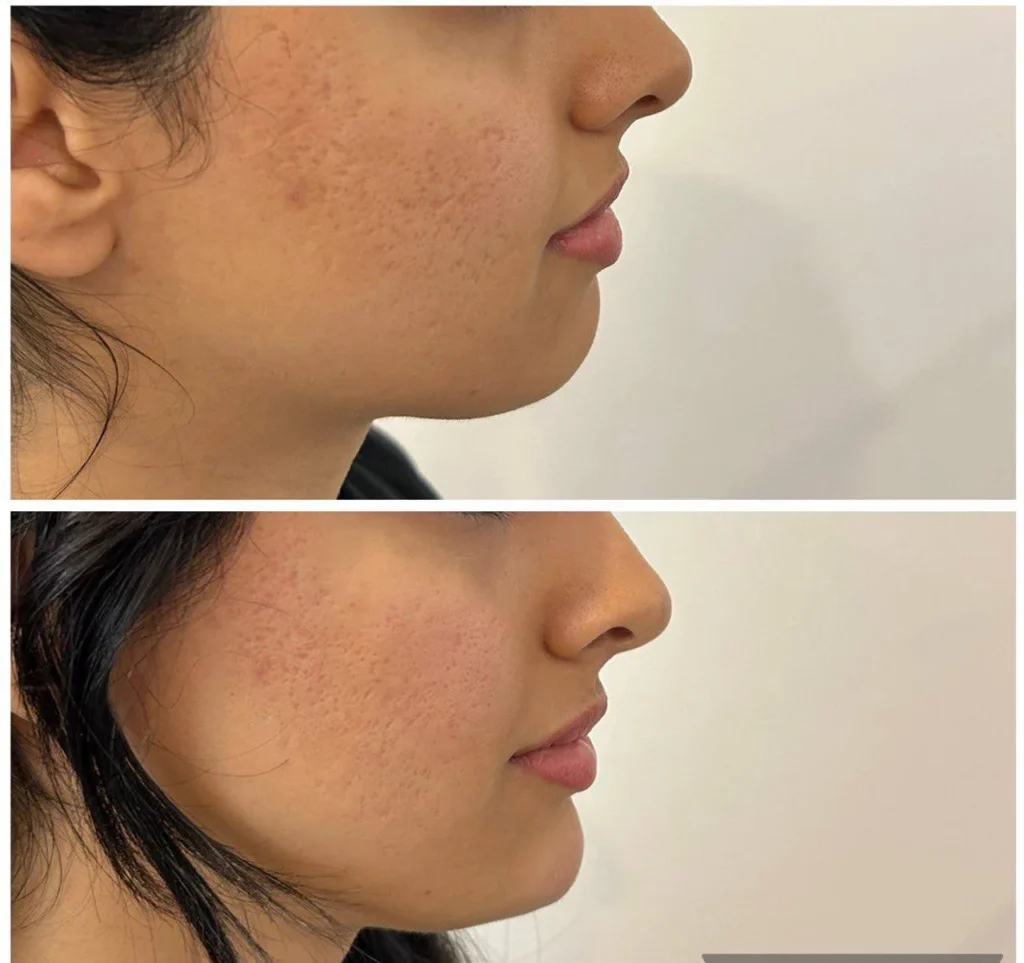 Chin filler before and after in profile in Dubai by Dr. Azra Vaziri — chin projection balanced with nose and lips