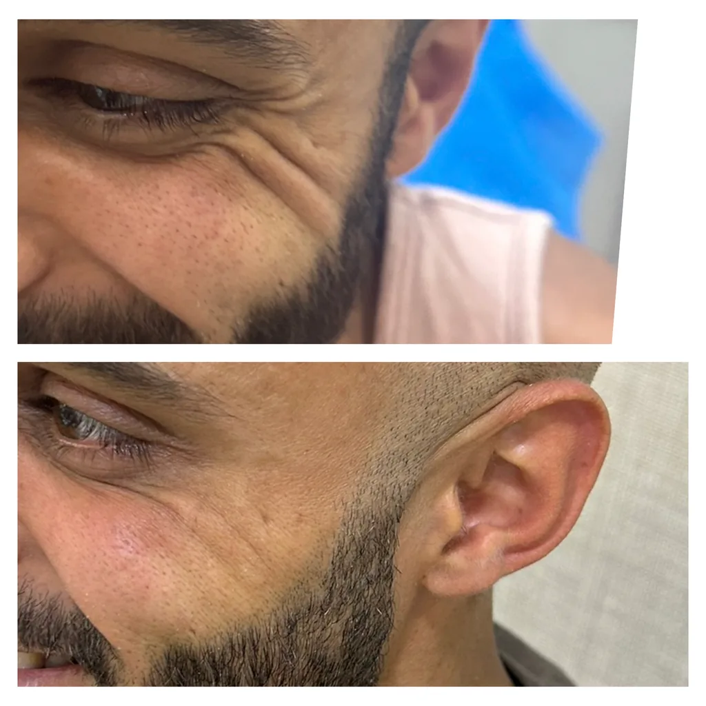 Crow’s feet Botox before and after in Dubai by Dr. Azra Vaziri — smile lines beside the eye softened, before (top) and after (bottom)