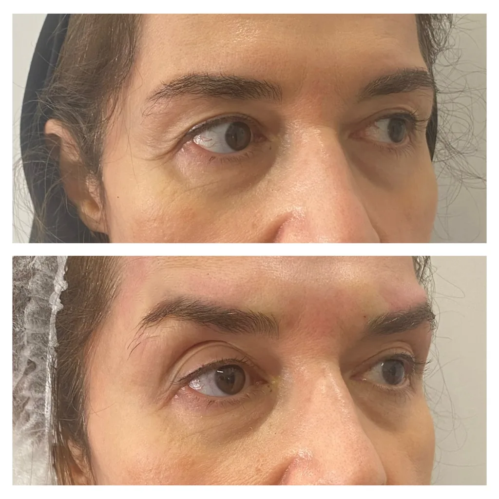 Eyebrow and upper eyelid thread lift before and after in Dubai by Dr. Azra Vaziri — a more open eye, before (top) and after (bottom)