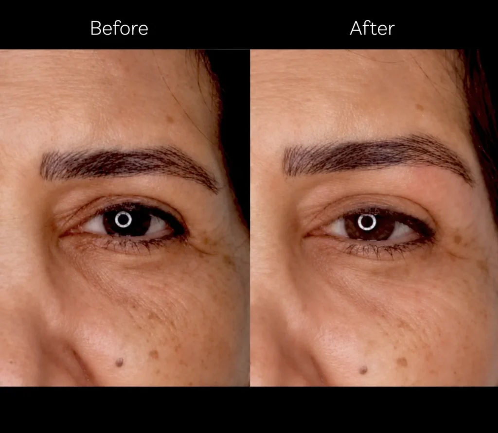 Eyebrow and temple lift with filler before and after in Dubai by Dr. Azra Vaziri — lifted brow tail