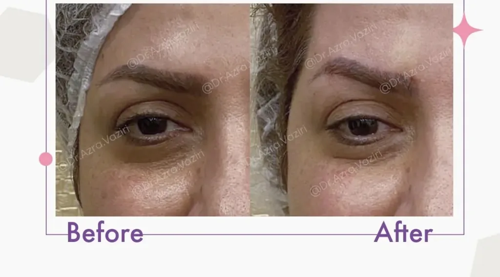Eyebrow thread lift before and after in Dubai by Dr. Azra Vaziri — brow tail lifted, before (left) and after (right)