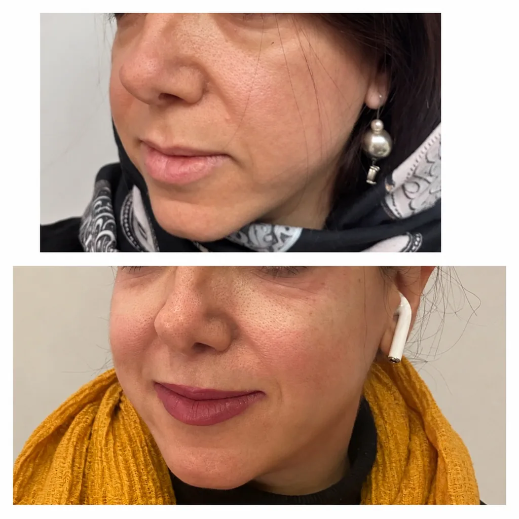 Face contouring with filler before and after in Dubai by Dr. Azra Vaziri — cheek and lower face rebalanced, before (top) and after (bottom)