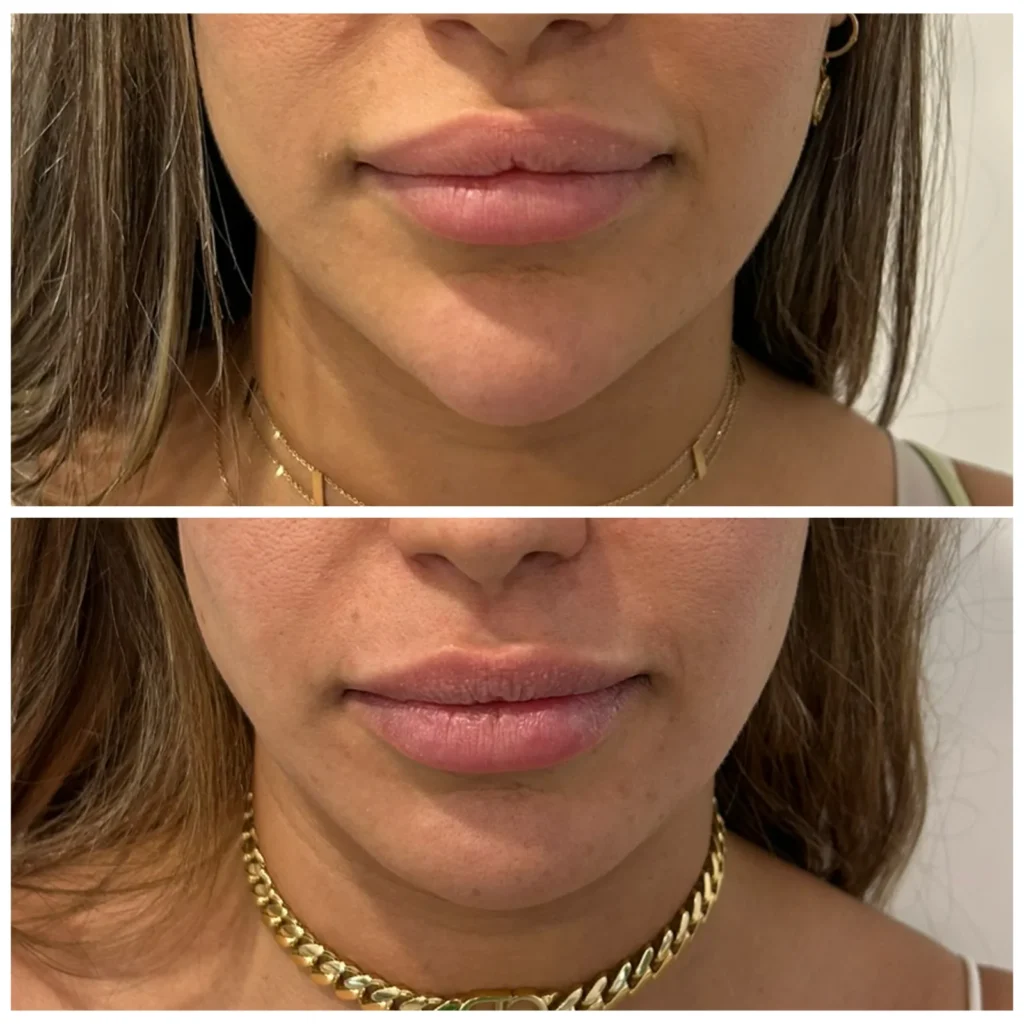 Chin and lip filler dissolved with hyaluronidase before and after in Dubai by Dr. Azra Vaziri — natural proportions restored