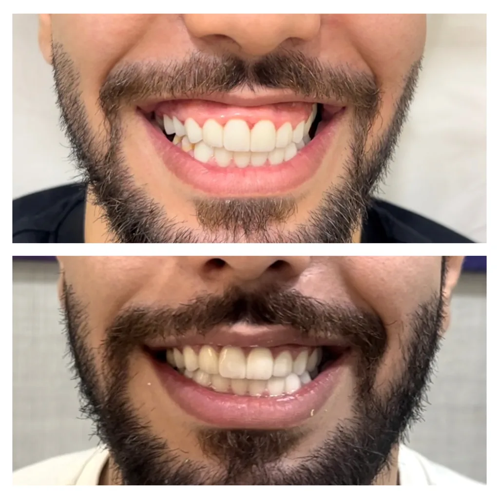Gummy smile Botox before and after in Dubai by Dr. Azra Vaziri — less gum show in a male patient, before (top) and after (bottom)