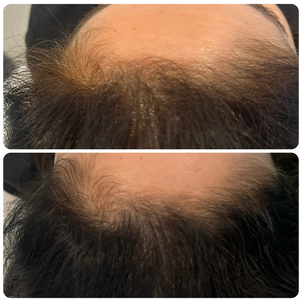 Hair filler before and after in Dubai by Dr. Azra Vaziri — denser hair along the parting and hairline