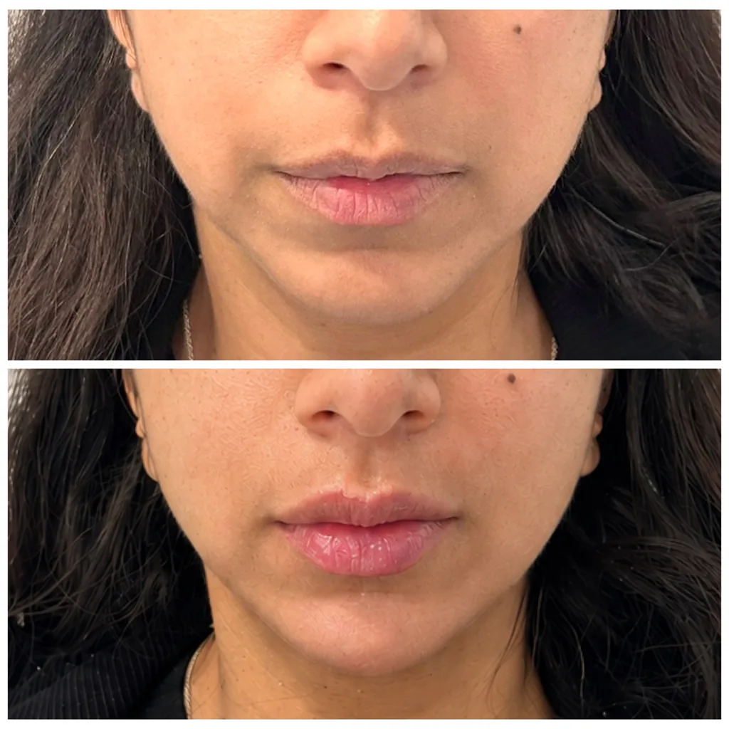 Lips and chin filler before and after in Dubai by Dr. Azra Vaziri — lip shape refined and the chin balanced, before (top) and after (bottom)
