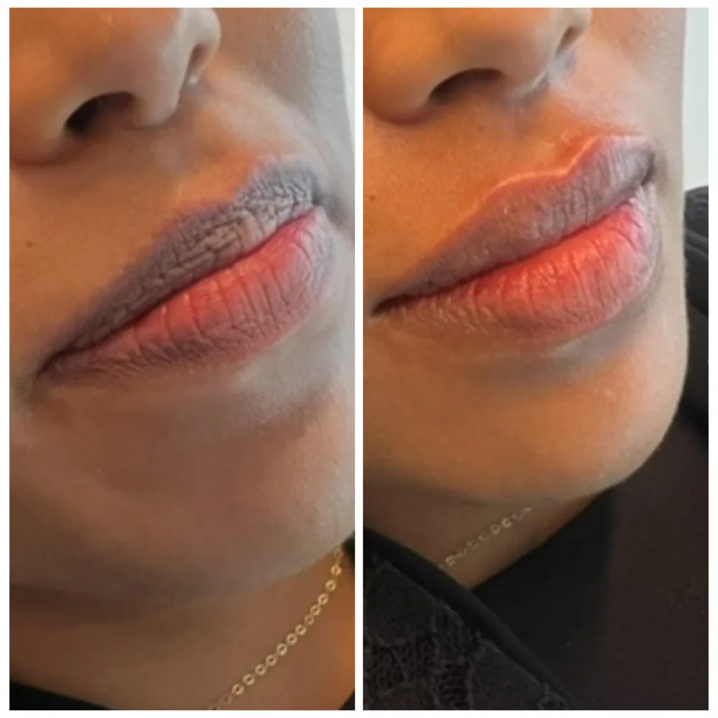 Lip filler with a lip booster before and after in Dubai by Dr. Azra Vaziri — hydrated, fuller lips, before (left) and after (right)