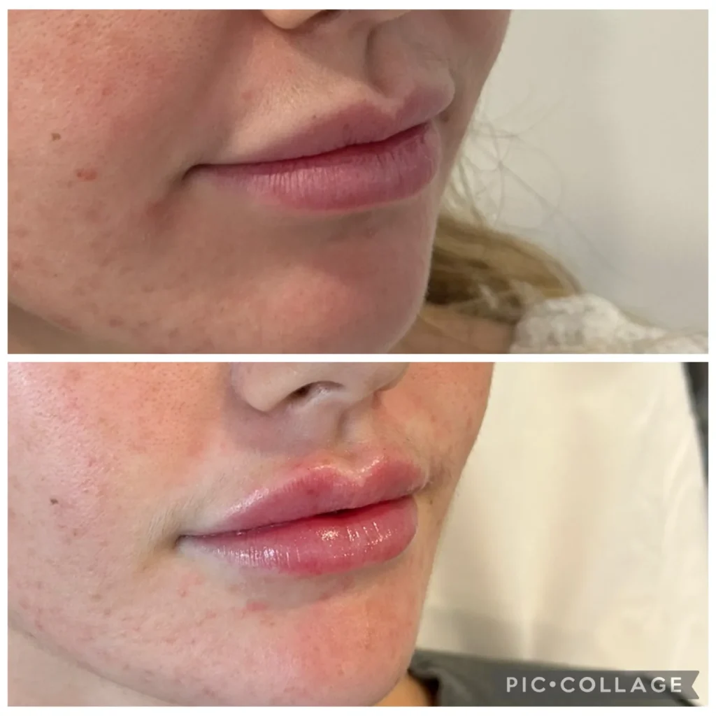 Lip filler dissolved and re-injected before and after in Dubai by Dr. Azra Vaziri — lip shape corrected
