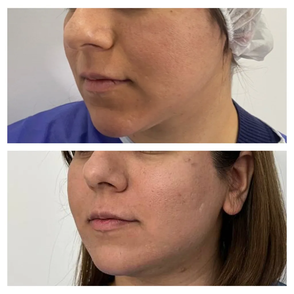 Marionette line thread lift before and after in Dubai by Dr. Azra Vaziri — mouth corners and jowl lifted, before (top) and after (bottom)