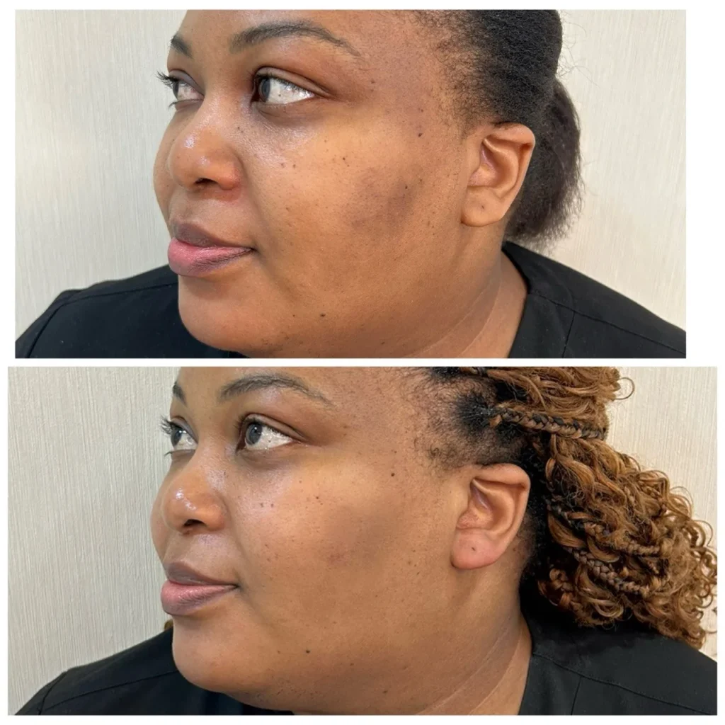 Melasma treatment before and after in Dubai by Dr. Azra Vaziri — pigmentation visibly lighter